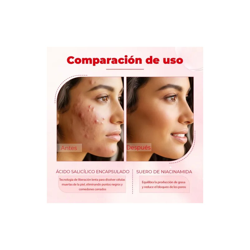 Loción Secante Antiacné Ácido Salicílico 10ml Oukeya