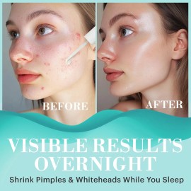 Repechage Tratamiento De Manchas De Acné Para Espinillas Bla