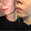 Dermz Acne Treatment - Acne Cream, SPF Face Protection, Face