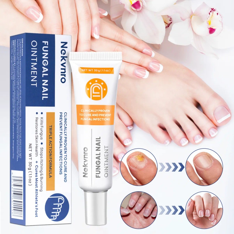 Pomada Antifúngica Para Uñas 30g,tratamiento Contra Hongos