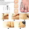 12PCS Ingrown Toenail Tool Stainless Steel Ingrown Toenail Treatment Pedicure