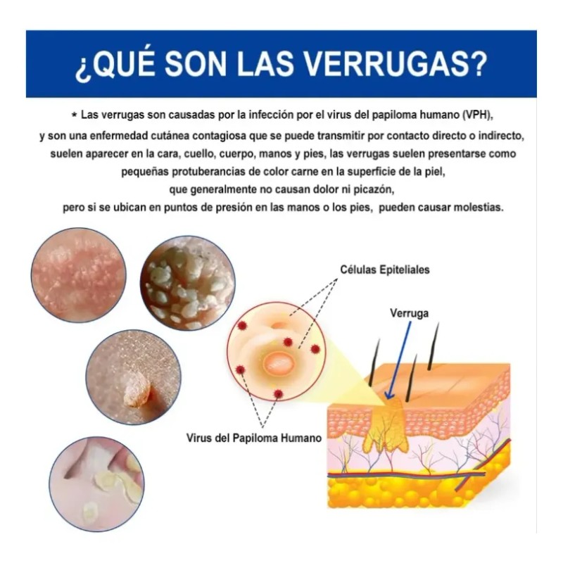 Líquido Mejorador De Verrugas Y Maíz Reva