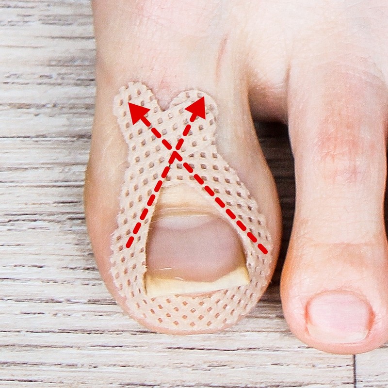 Additional pincher tape ingrown toenail corrector ingrown toenail correction band