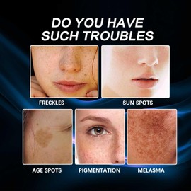 Removedor de manchas oscuras para la cara, crema facial que elimina las pecas con vitamina C, crema hidratante blanqueadora para pecas para pieles secas, grasas y mixtas, cuidado de la piel