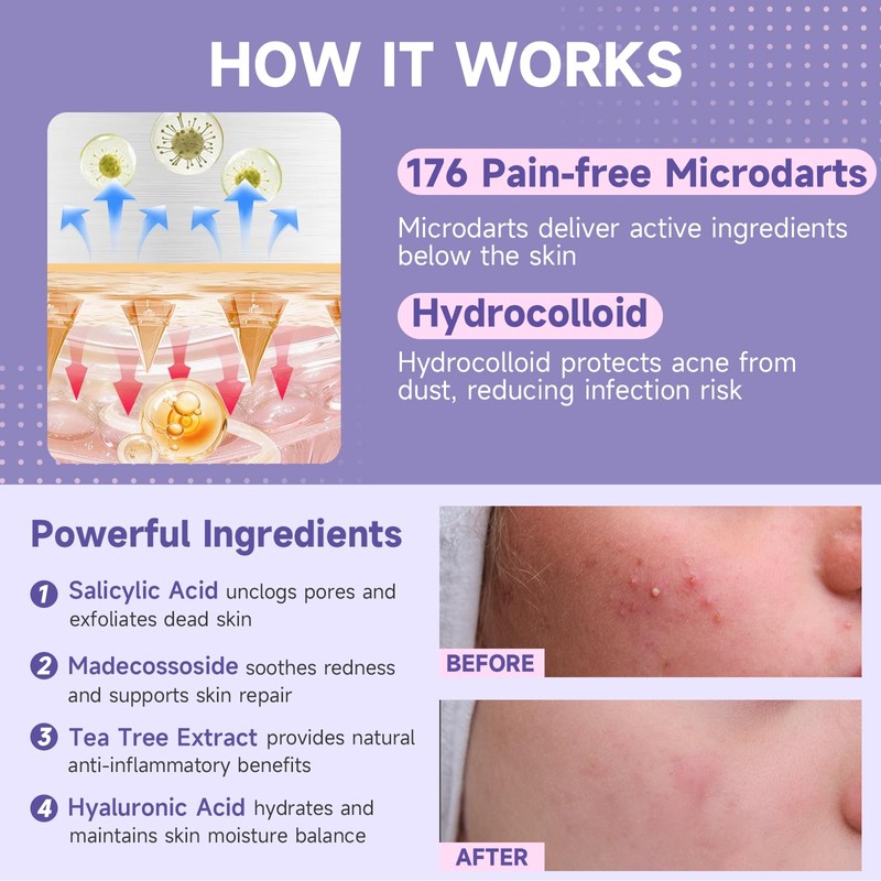 36-Count Microdart Acne Patches, Cute Round-shaped microdart pimple patch
