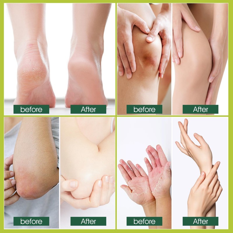 Cracked Foot Cream Roll-On Moisturizer, 1.76floz