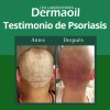 Shampoo Natural Para Psoriasis Capilar: Alivio Y Renovación