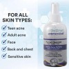 Skinsmart Hypochlorous Acid Spray Acne Cleanser
