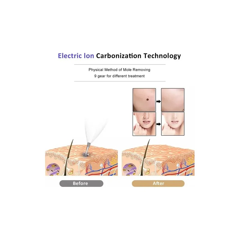 Herramienta Para Quitar Verrugas Condilomas Vph Zona Bikini