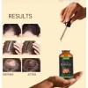 Aceite De Batana For El Crecimiento Del Cabello Con 1pcs