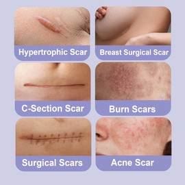 Ourmed Silicone Scar Removal Sheets (1.6" x 6", Pack of 5) Medical Grade Silicone Scar Removal Sheets, Hypoallergenic for New and Old Scars – Surgery, Burns, Acne, Keloids, Stretch Marks, C-Section