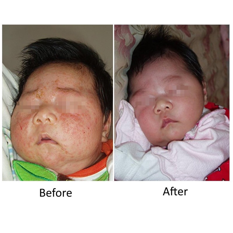 Lingon Emulsion - 2 15ML