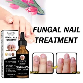EELHOE Nail Treatment Thickening & Shining Nail Removal Dead Skin Repairing & Moisturising Nail Nutritional Care Solution - Specification: 2 piece