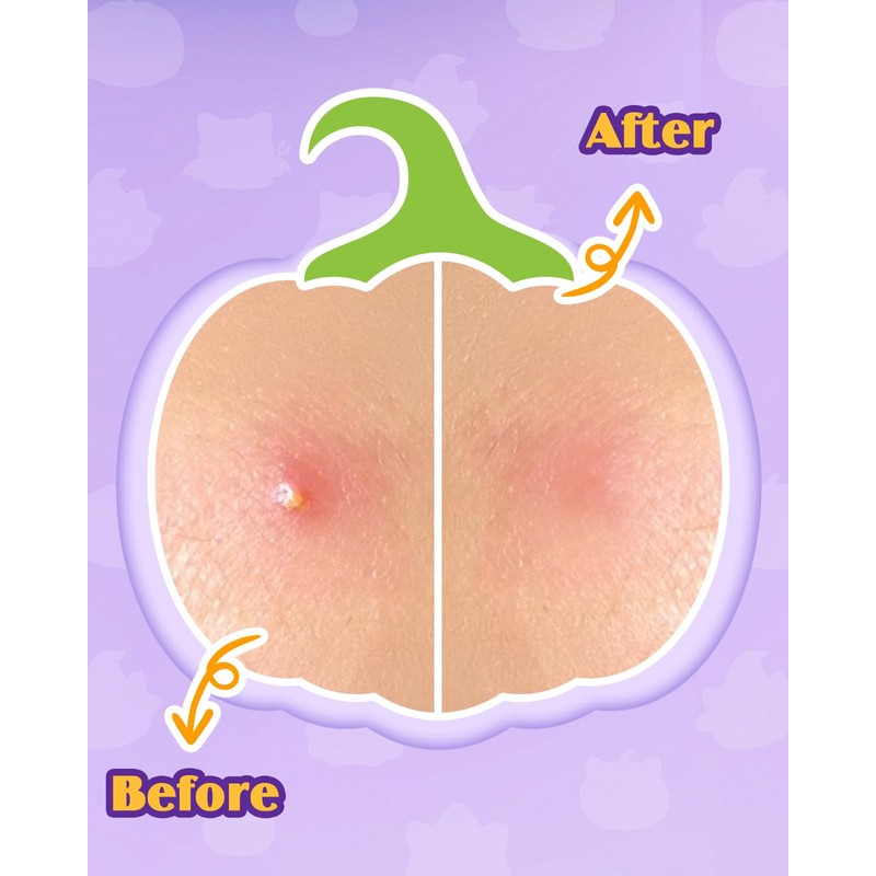 Halloween Cute Cat Acne Pimple Patches for Face, Hydrocolloid