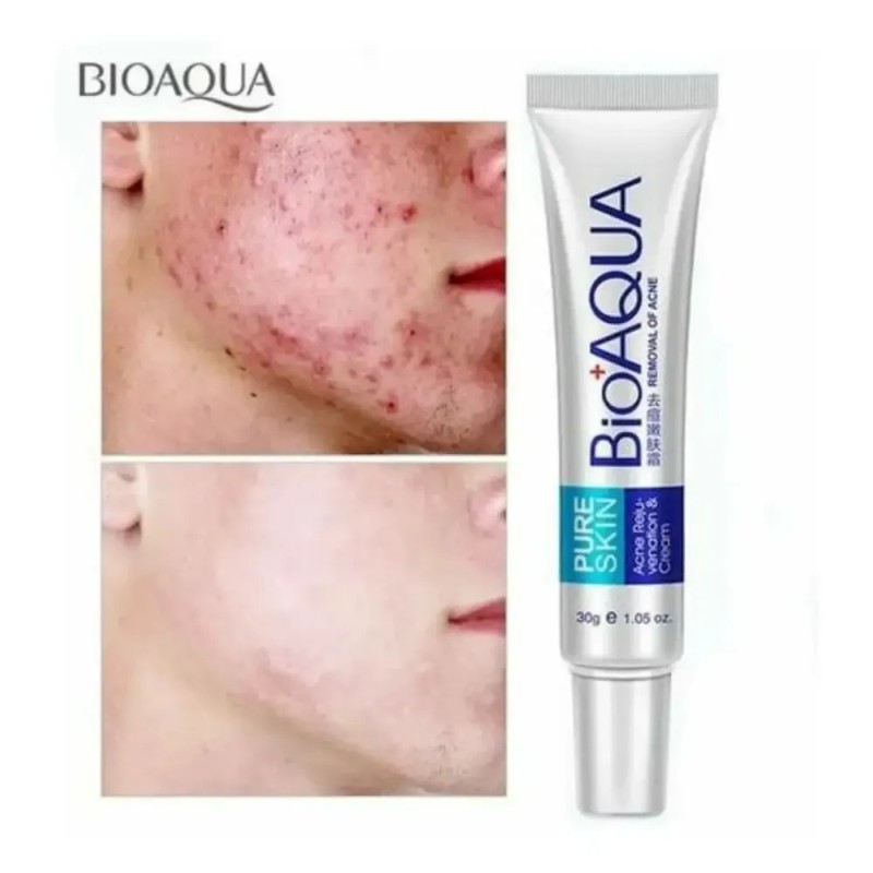 Bioaqua Acne Cream reduce cicatrices, poros y grasa, cuidado continuo