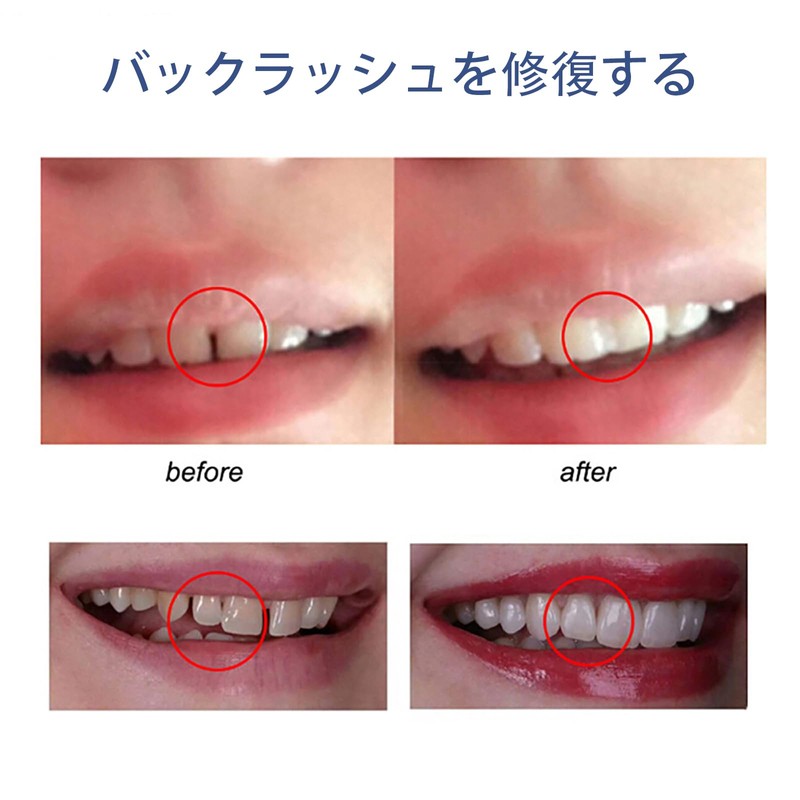 ALLVD Dental Resin Denture Repair Kit, Temporary Denture Replacement Kit,