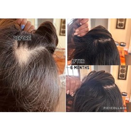 Suero para el cuero cabelludo de Pelo Naturals | Suero para el crecimiento del cabello para mujeres y hombres | Ideal para la caída y debilitamiento d