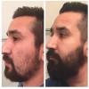 Rodillo Para Estimular Crecimiento Barba Vello Facial Cabell