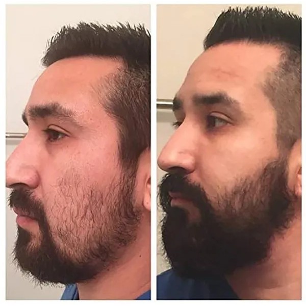 Rodillo Para Estimular Crecimiento Barba Vello Facial Cabell