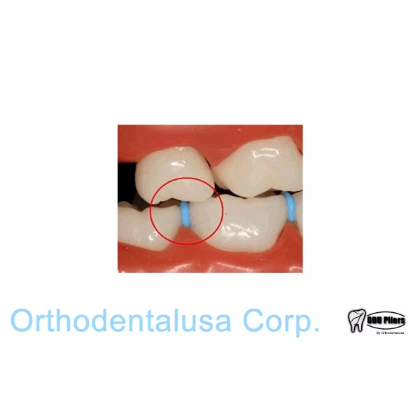 ORTHODENTALUSA CORP 1,000 ELASTIC TOOTH SEPARATORS POSTERIOR Blue SMALL RADIOPAQUE