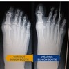 Bunion Corrector for Women Big Toe Straightener. Ultra-Thin Corrective Socks