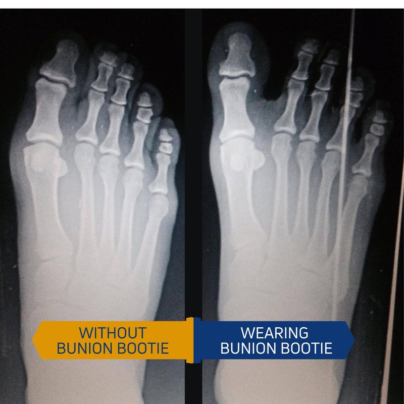 Bunion Corrector for Women Big Toe Straightener. Ultra-Thin Corrective Socks