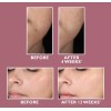 Niacinamide 10% +Zink 1% +Hyaluronic Acid | Acne/Blemish/Oil Control Serum/Cream