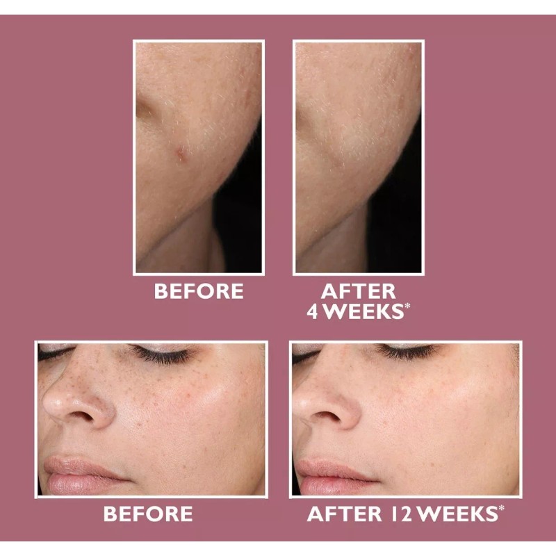 Niacinamide 10% +Zink 1% +Hyaluronic Acid | Acne/Blemish/Oil Control Serum/Cream