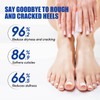 60% Urea Cream - Cracked Heel Repair Cream For Feet