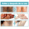2PCSAcanthosis Nigricans Crema, Crema Correctora de Manchas Oscuras,Ilumina el Tono
