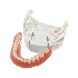 Dental Implant Teeth Restoration Model Mandibular Overdenture with 2 Implants
