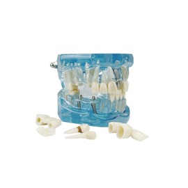 SENLIN DENTAL Transparent Disease Teeth Model with Dental Implant Bridge, Compact and Convenient Dental Models for Patient and Dental Student Education (Blue)
