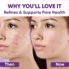 Anti-imperfecciones Y Aclarante Piel Acneica