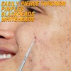Acne Remover Tools,Nose Acne Remover Stainless Made Blackhead Remover Tool