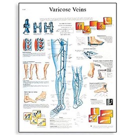 3B Scientific VR1367L Glossy Laminated Paper Varicose Veins Anatomical Chart, Poster Size 20" Width x 26" Height