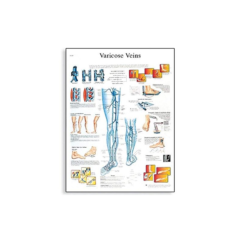 3B Scientific VR1367L Glossy Laminated Paper Varicose Veins Anatomical Chart,