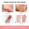 MKNZOME 3 Pairs Foot Peel Mask, Repair Cracked Heels &