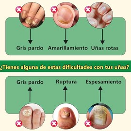 LUSCOR 2pcs Ginger Nail，Treatment Nail Support Nail Care，Tratamiento de Uñas con Jengibre，Reparación de uñas de los pies, Cuidado multiusos, Suero de 
