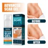 Crema Para Cicatrices En Gel Queloid Acne Removal Treatment,