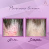 Psoriasis Cream, Facial Corporal Psoriasis Aliviante.