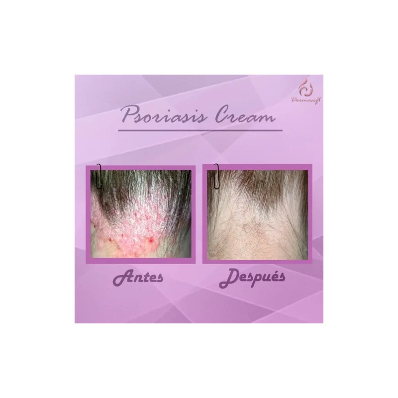 Psoriasis Cream, Facial Corporal Psoriasis Aliviante.