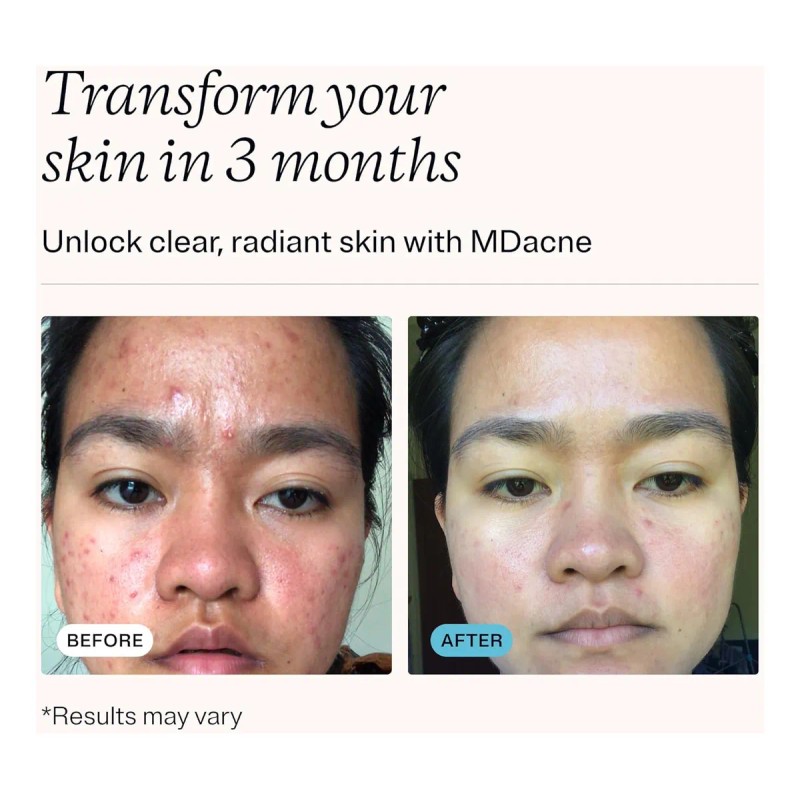 Mdacne Kit De Tratamiento Para El Acné Con Peróxido De