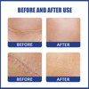 8PCS Chest Scar Patch 8PCS Nipple Patch Silicone Skin Scars