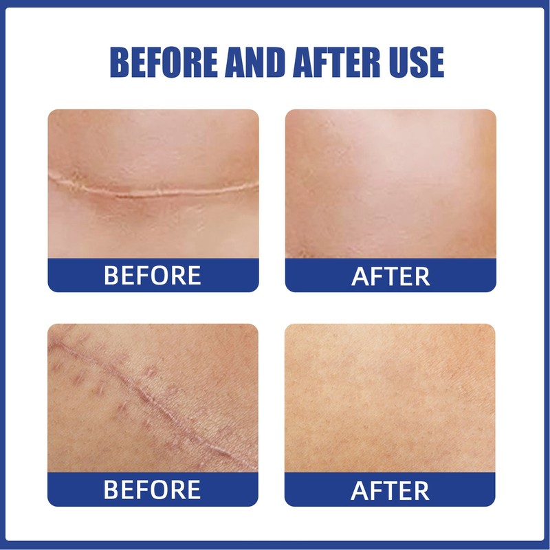 8PCS Chest Scar Patch 8PCS Nipple Patch Silicone Skin Scars