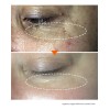 Eliminador De Oscuridad Para Hiperpigmentación Facial, Melas