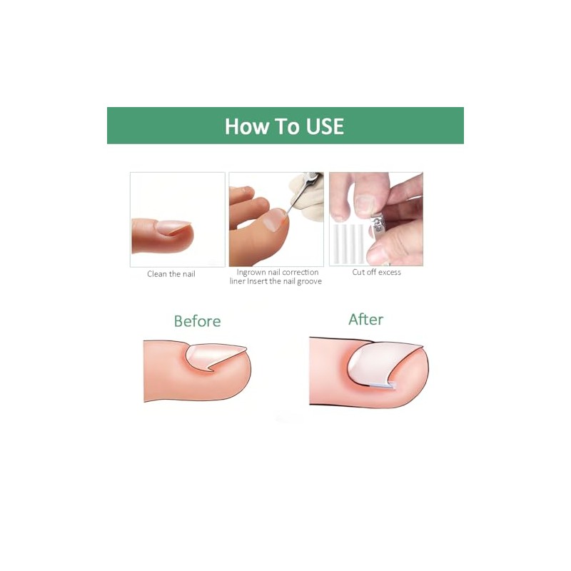 Professional Ingrown Toenail Treatment Set for Home Use