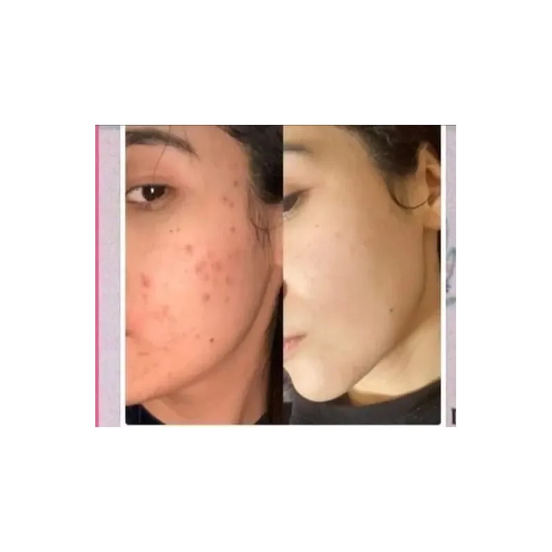 Crema Aclaradora Quita Manchas Paño Y Sol Melasma