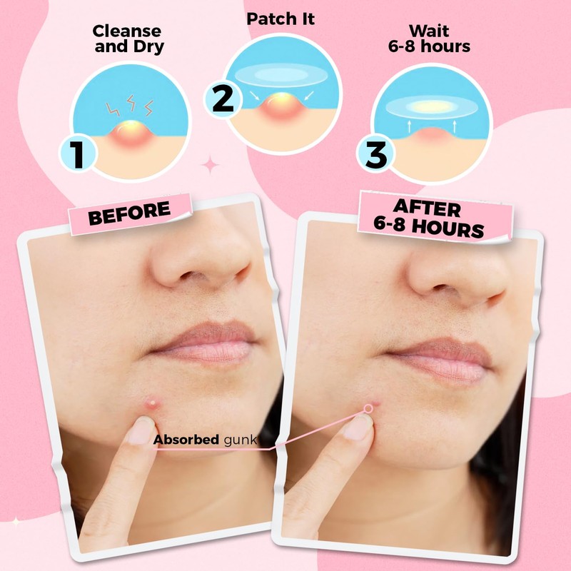 PurePatch Pimple Patches - Breakout Pack - 96Circle,10Nose, 10Chin. Hydrocolloid