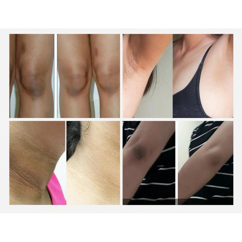 Crema gel blanqueador de piel oscura ultra blanqueador aclarador edad