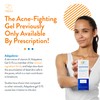 Acne Free Adapalene Gel 0.1%, Once-Daily Topical Retinoid Acne Treatment,